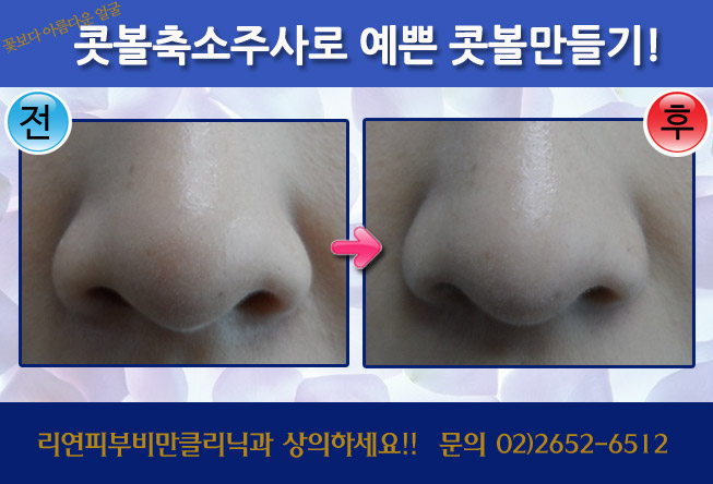 콧볼축소주사