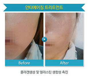 리연클리닉_밀크필_시술안내_전후사진