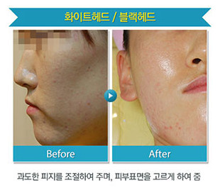 리연클리닉_밀크필_시술안내_전후사진3