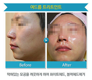 리연클리닉_밀크필_시술안내_전후사진4