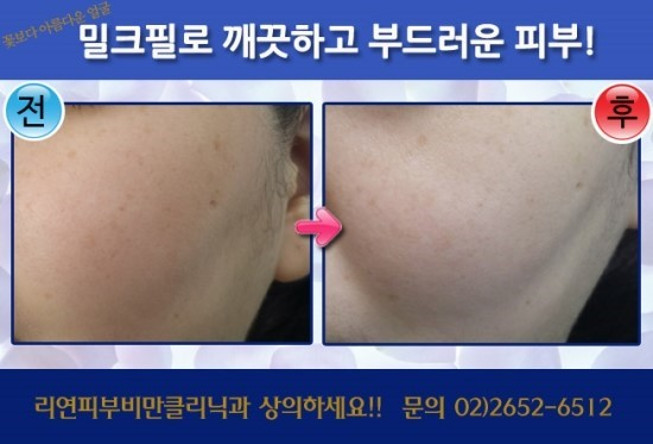 리연클리닉_밀크필_전후사진