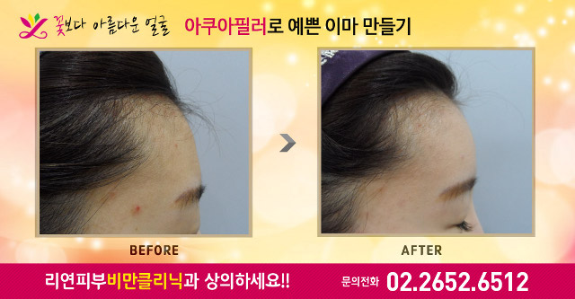 리연클리닉 아쿠아필러 이마필러 전후사진