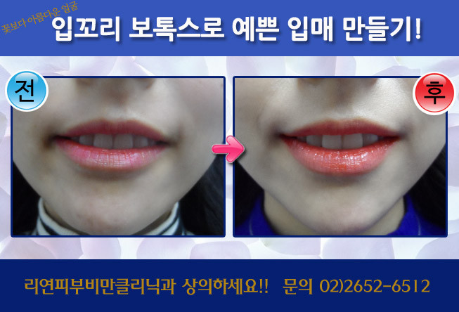 리연클리닉 입꼬리보톡스 전후사진