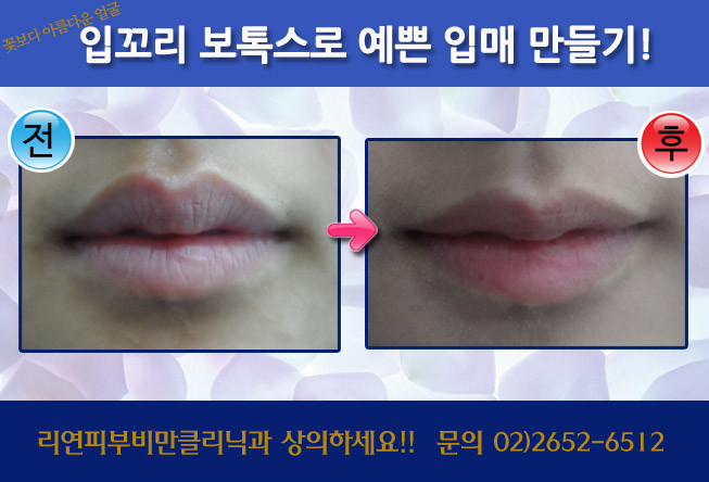 리연클리닉 입꼬리보톡스 전후사진