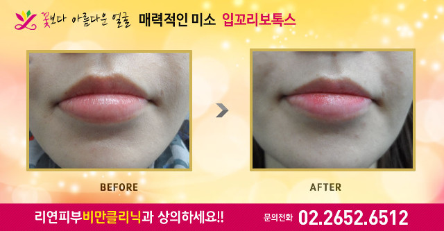 리연클리닉 입꼬리보톡스 전후사진