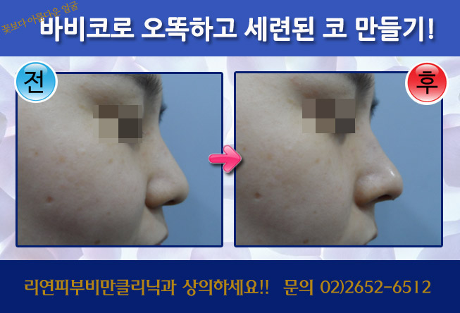 리연클리닉 바비코 전후사진