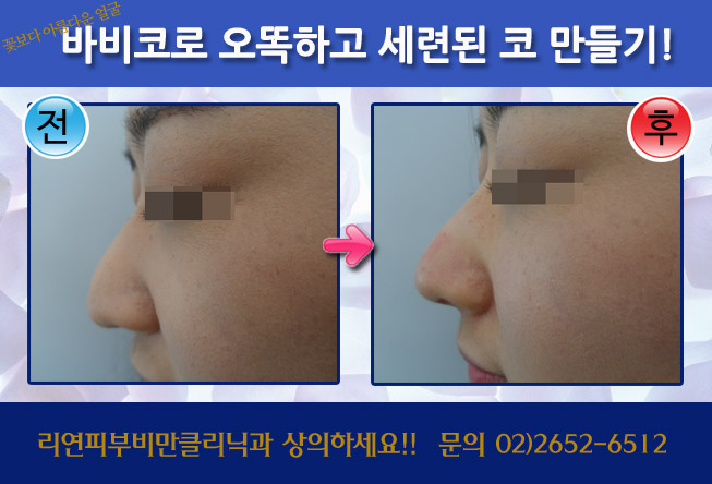 리연클리닉 바비코 전후사진