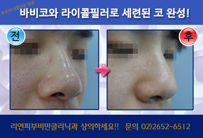 리연클리닉 바비코 전후사진