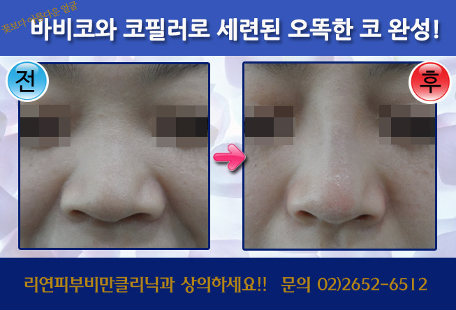 리연클리닉 바비코 전후사진