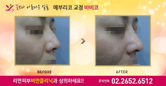 리연의원 바비코 하이코 탑스코 전후사진