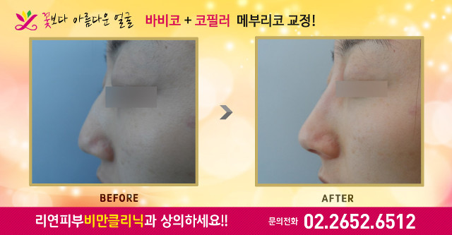 리연클리닉 바비코성형 전후사진