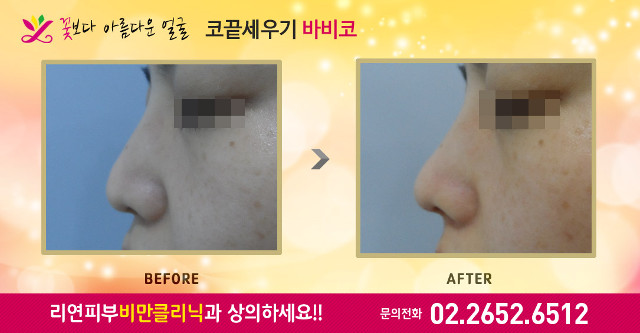 리연클리닉 바비코성형 전후사진