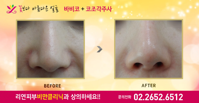 리연클리닉 바비코 코조각주사 전후사진