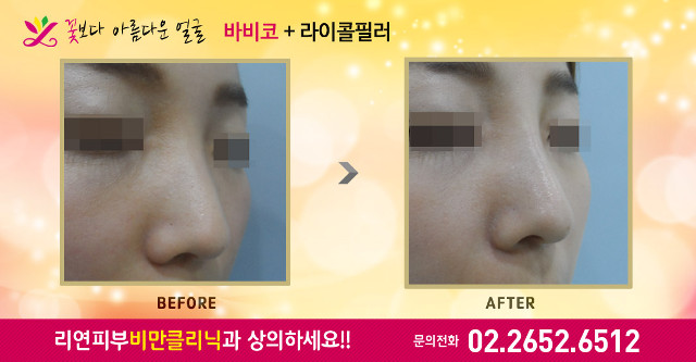 리연클리닉 바비코성형 전후사진