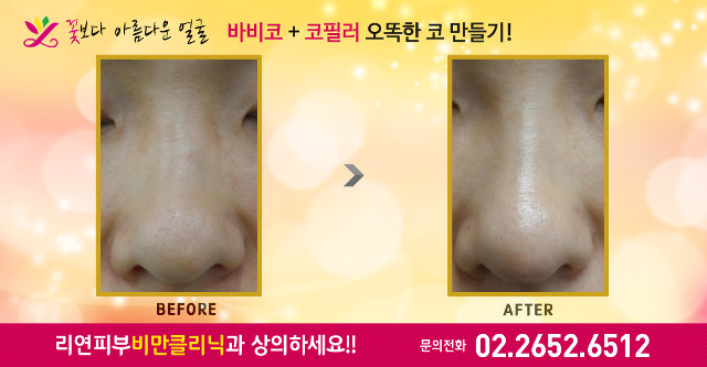 리연클리닉 바비코성형 전후사진