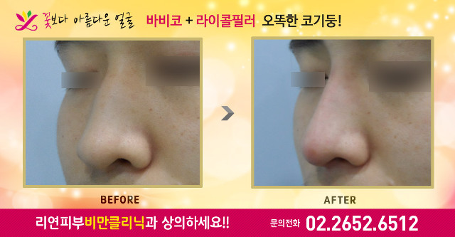 리연클리닉 바비코 코필러 전후사진