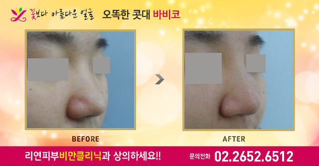 리연클리닉 바비코성형 전후사진