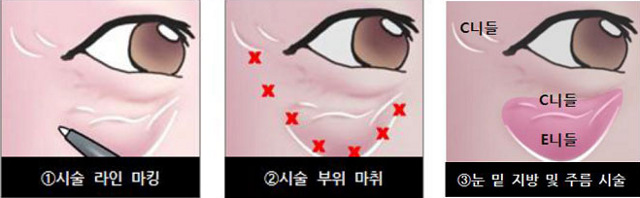 눈밑지방제거 시술순서