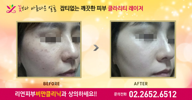 리연클리닉 클라리티레이저 전후사진