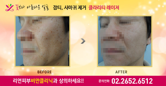 리연의원 잡티 사마귀 전후사진