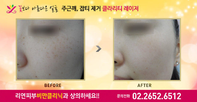 리연클리닉 클라리티레이저 잡티제거 전후사진