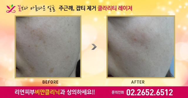 리연클리닉 클라리티레이저 주근깨 잡티제거 전후사진