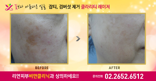 리연클리닉 잡티 검버섯 전후사진