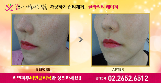 리연클리닉 클라리티레이저 잡티제거 전후사진
