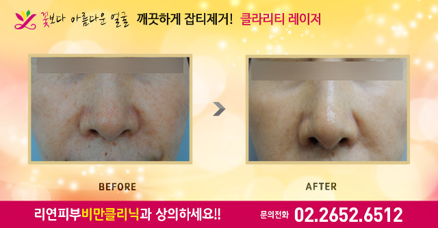 리연클리닉 클라리티레이저 잡티제거 전후사진