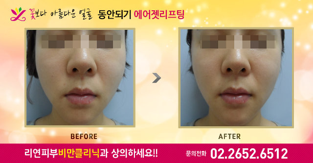 리연클리닉 에어젯리프팅 전후사진