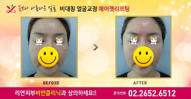 리연클리닉 에어젯리프팅 전후사진