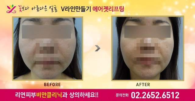 리연클리닉 에어젯리프팅