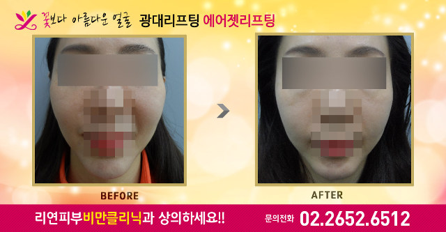 리연클리닉 에어젯리프팅