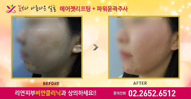 리연클리닉 에어젯리프팅 파워윤곽주사
