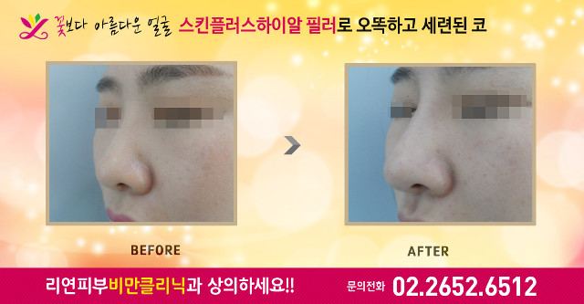 리연의원 코필러 바비코 전후사진