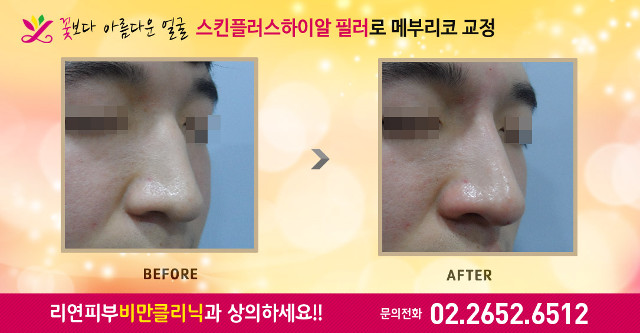 리연클리닉 메부리코 코필러 전후사진