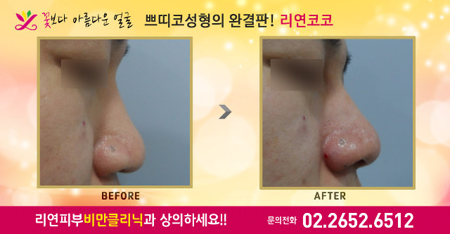 리연클리닉 코필러 바비코 리연코코 전후사진