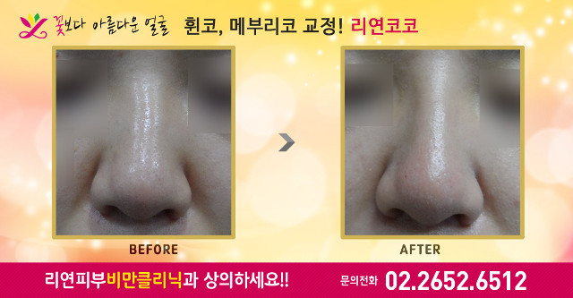 리연클리닉 휜코 메부리코 코필러 바비코 전후사진