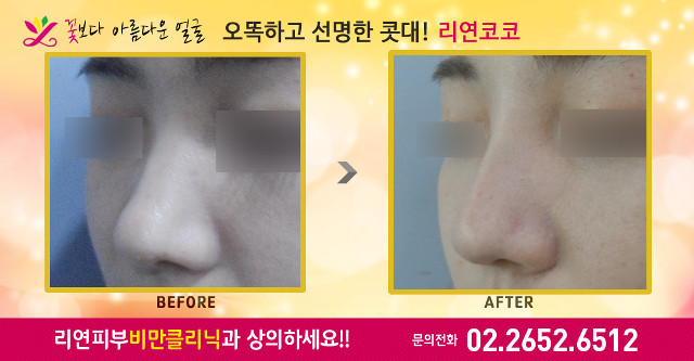 리연의원 코필러 바비코 전후사진