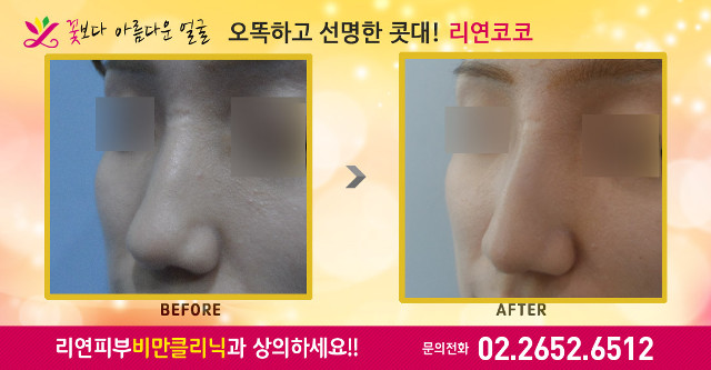 리연클리닉 리연코코 코필러 바비코 콧대 전후사진