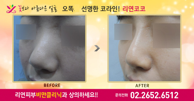 리연클리닉 리연코코 코필러 바비코 콧대 전후사진