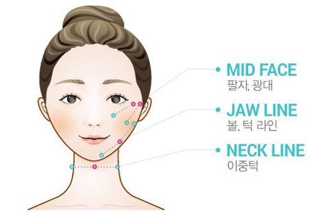 실루엣소프트 시술부위