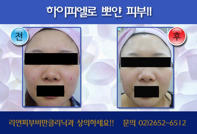 리연클리닉_하이피엘_전후사진