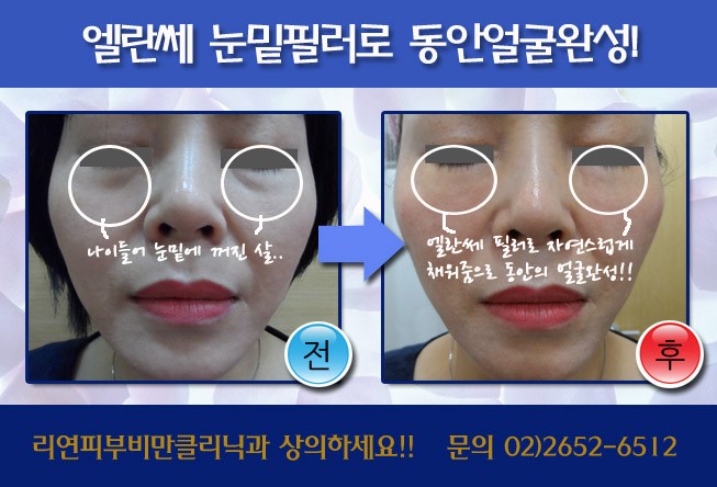 리연클리닉 눈밑 엘란쎄필러