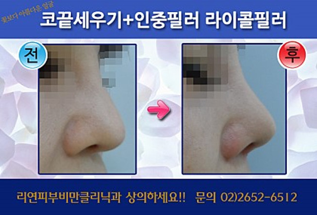 리연클리닉 쁘띠코성형 전후사진