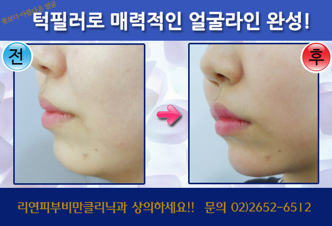 리연클리닉 라이콜필러 무턱필러