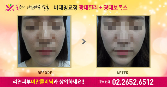 리연클리닉 광대필러 전후사진