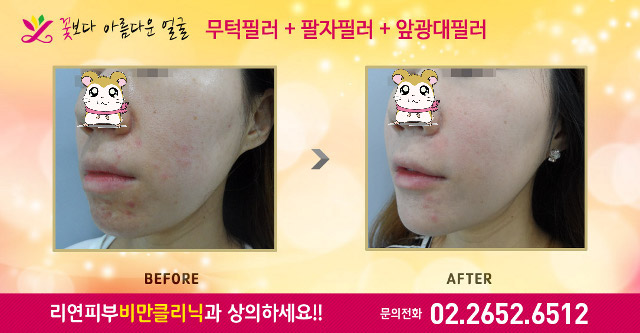 리연의원 돌출입 앞광대필러  전후사진