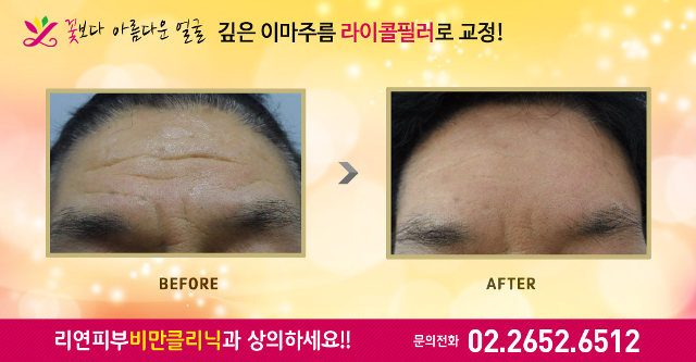 리연클리닉 볼필러 전후사진