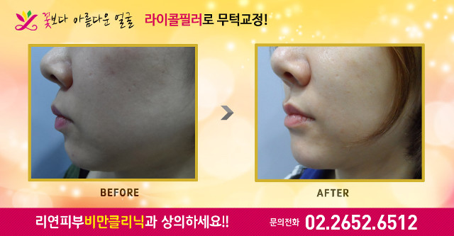 리연클리닉 무턱필러 전후사진